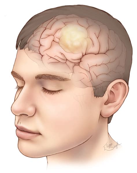 glioma brain tumor treatment surgery